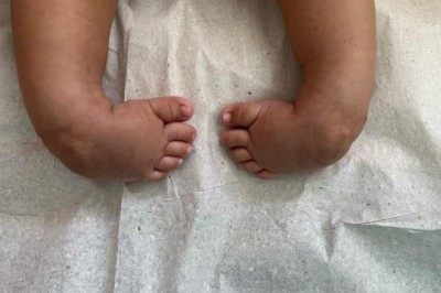 Cirurgias para tratar “pé torto” transformam a vida de crianças  em Aparecida de Goiânia